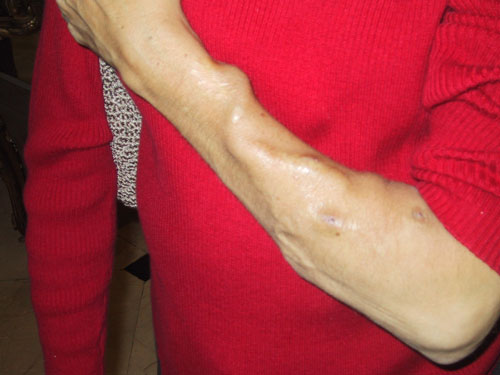Judy Weintraub showing her AV fistula